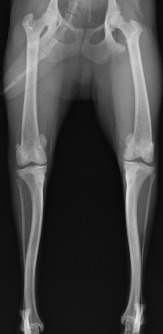 術前の両側膝関節のレントゲン画像像