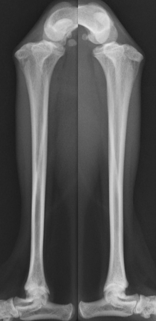 術前の両側膝関節のレントゲン画像