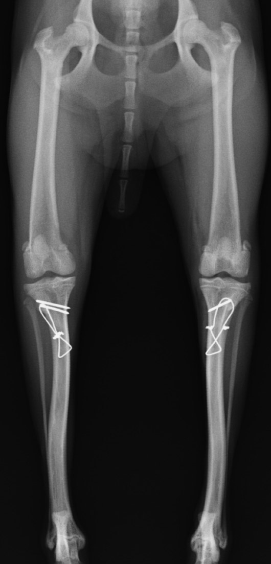 術後の両側膝関節のレントゲン画像