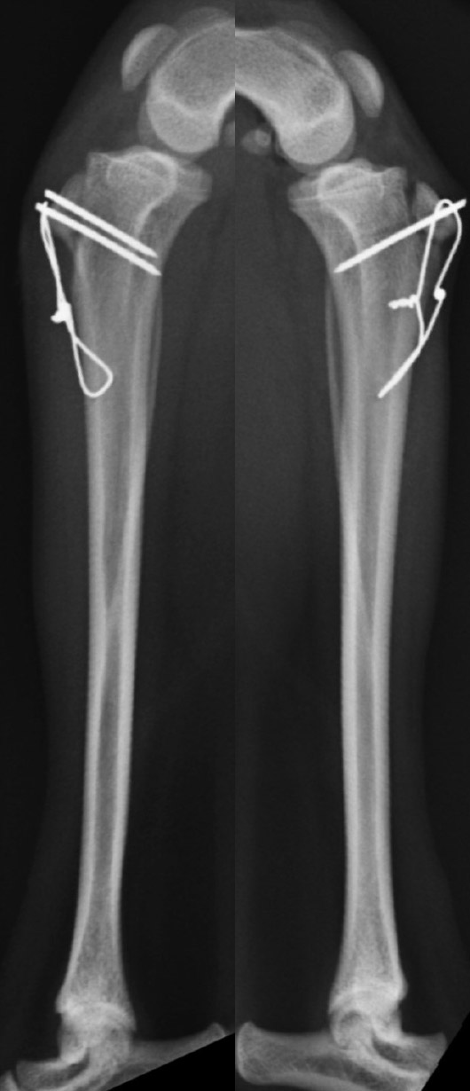 術後の両側膝関節のレントゲン画像