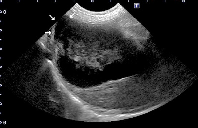 胆嚢粘液嚢腫が原因で破裂した胆嚢の超音波画像