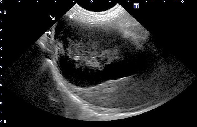 胆嚢粘液嚢腫が原因で破裂した胆嚢の超音波画像