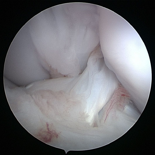 正常な前十字靱帯の関節鏡画像