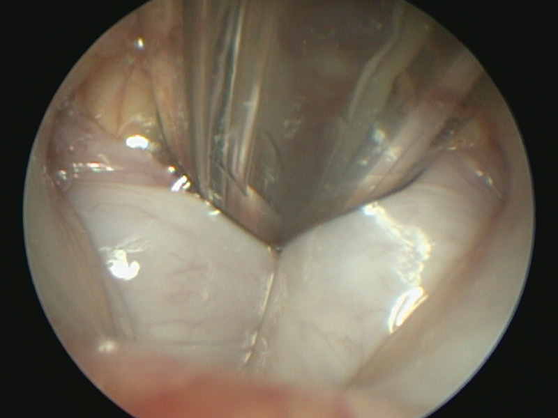 Everted Laryngeal Saccules