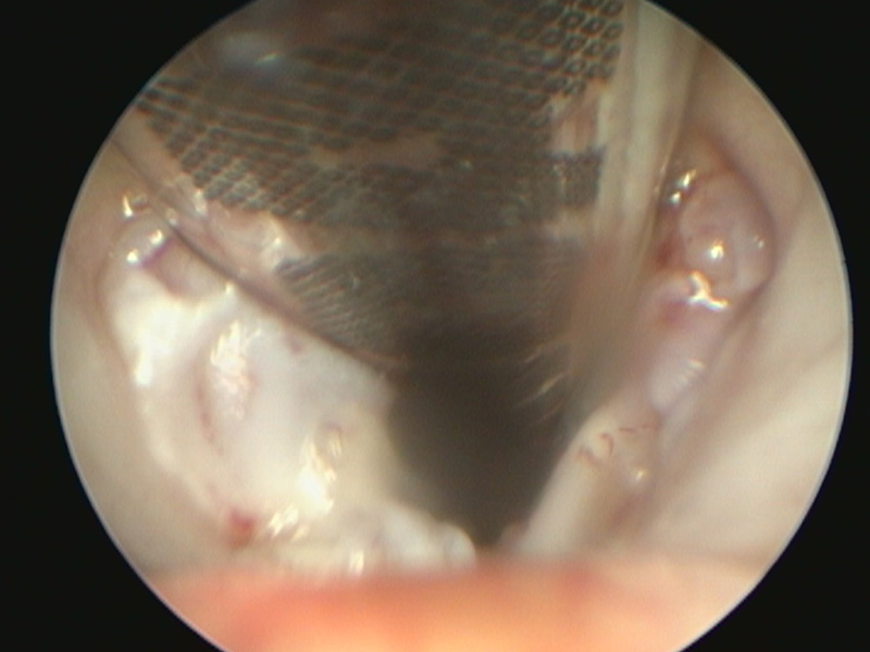 Laryngeal Sacculectomy