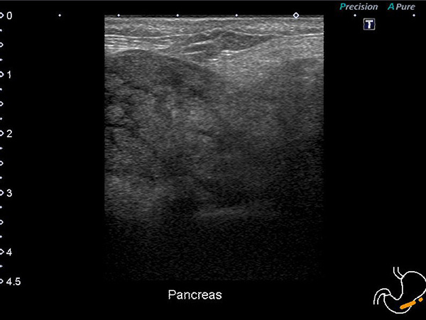 急性膵炎の超音波検査