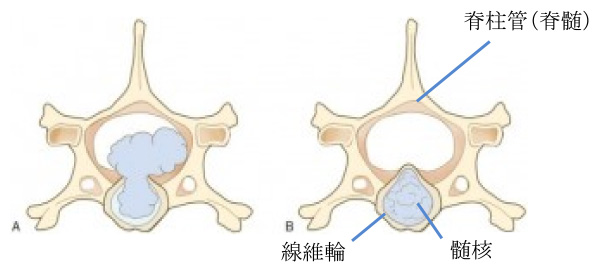 椎間板ヘルニアのイメージ